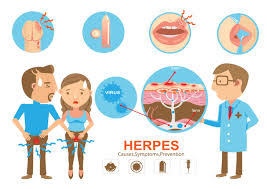 herpes