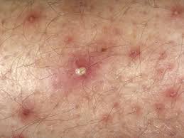 herpes outbreak